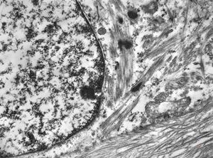 F,17y. | neck - rhabdomyosarcoma